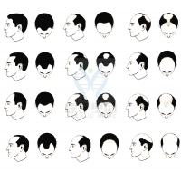 【巅峰国际基因检测】过早<font color='red'>脱发</font>、掉发太多怎么办？你的方法可能是错的！